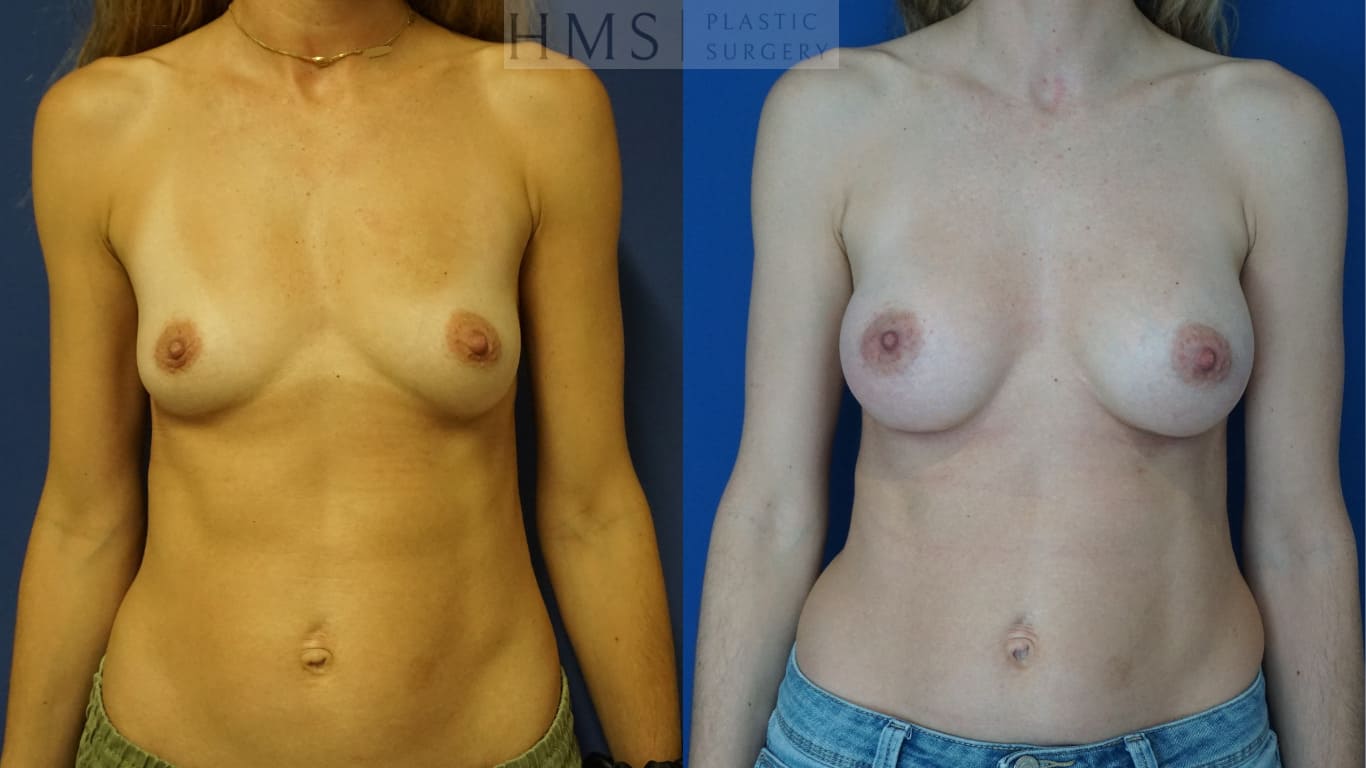 before and after Breast Augmentation procedure