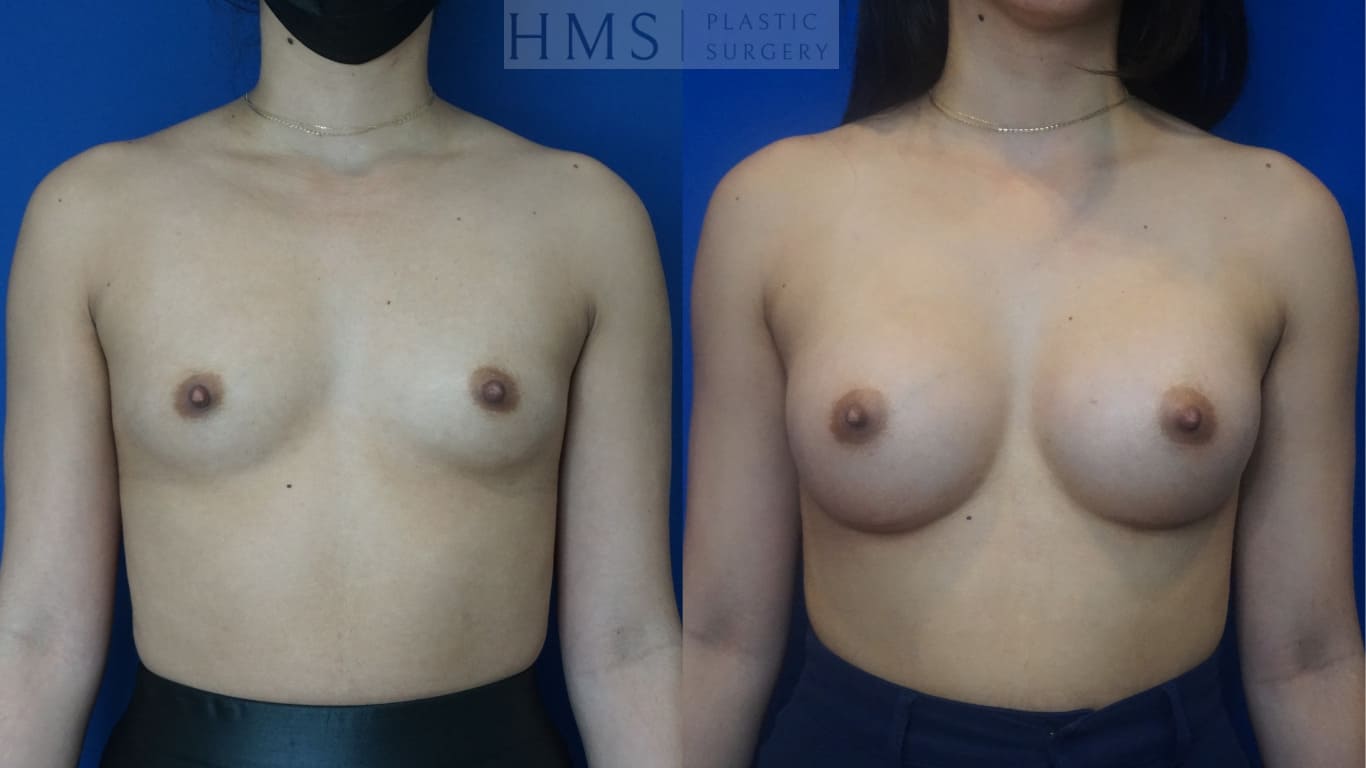 before and after Breast Augmentation procedure