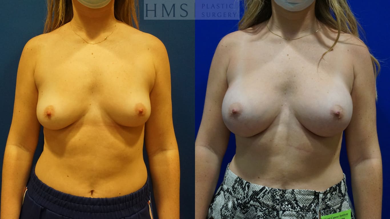 before and after Breast Augmentation procedure
