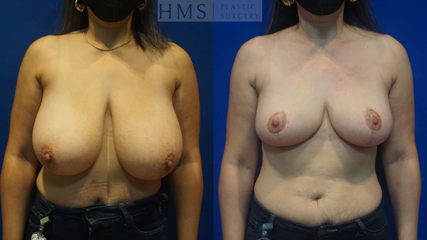 before and after Breast Reduction procedure