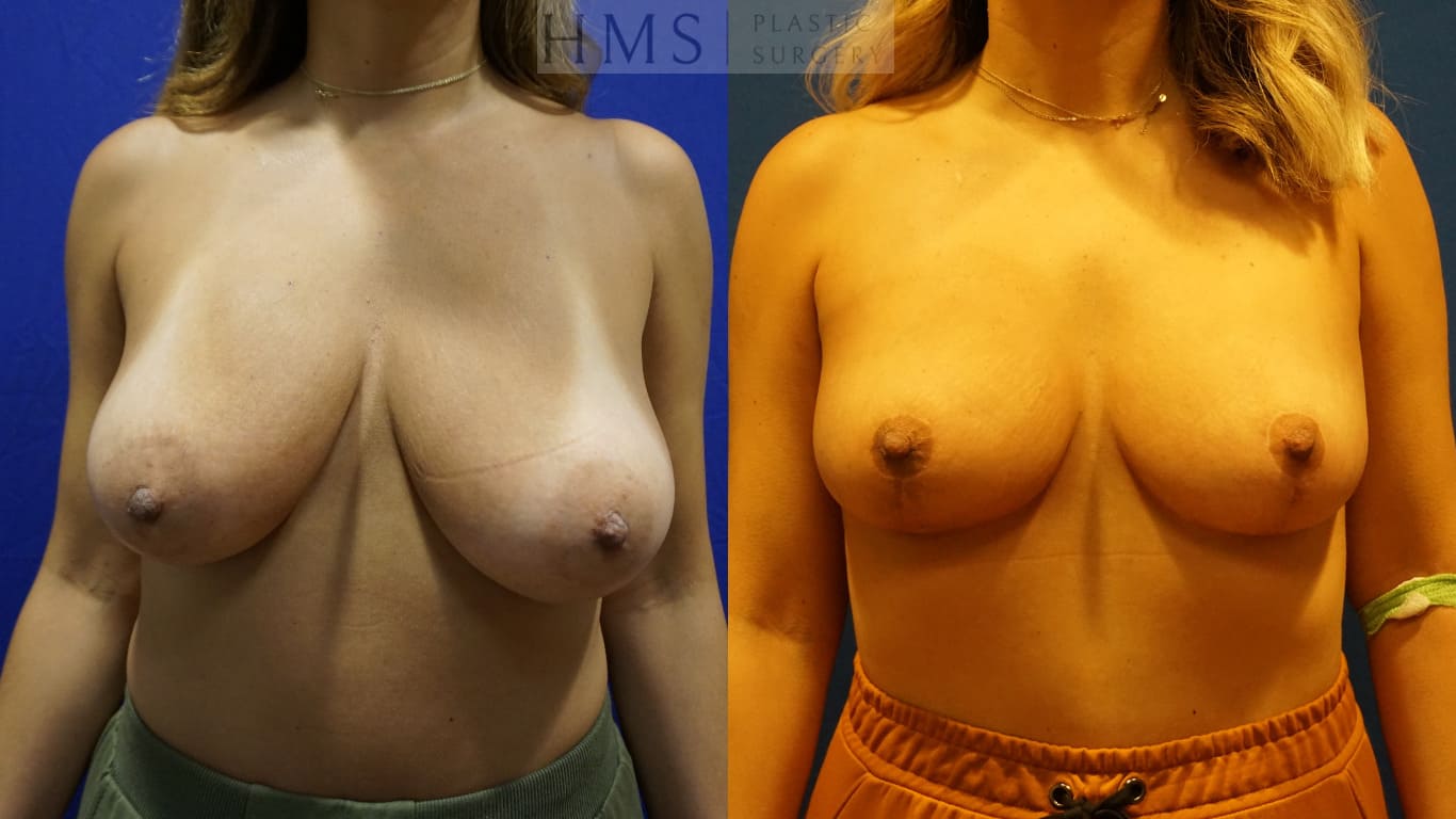 before and after Breast Reduction procedure