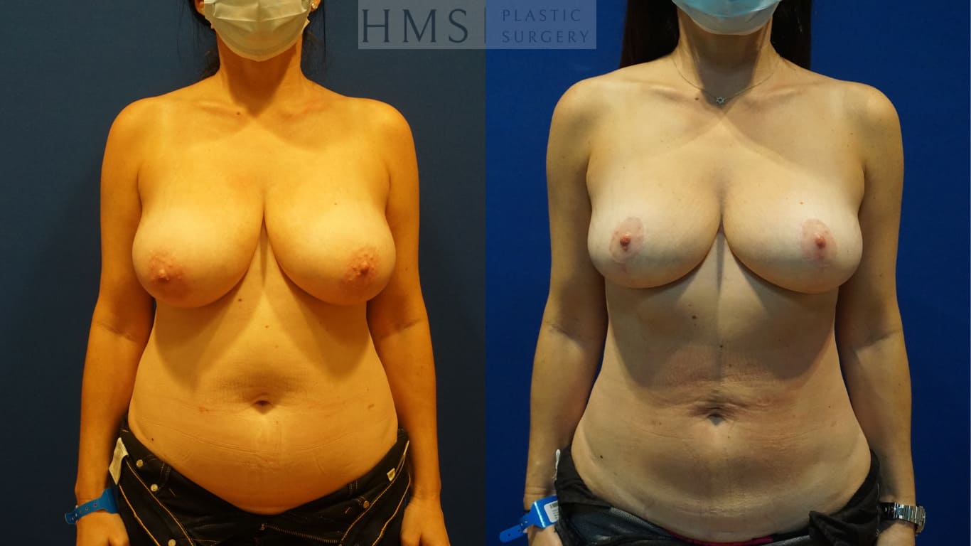 before and after Breast Reduction procedure