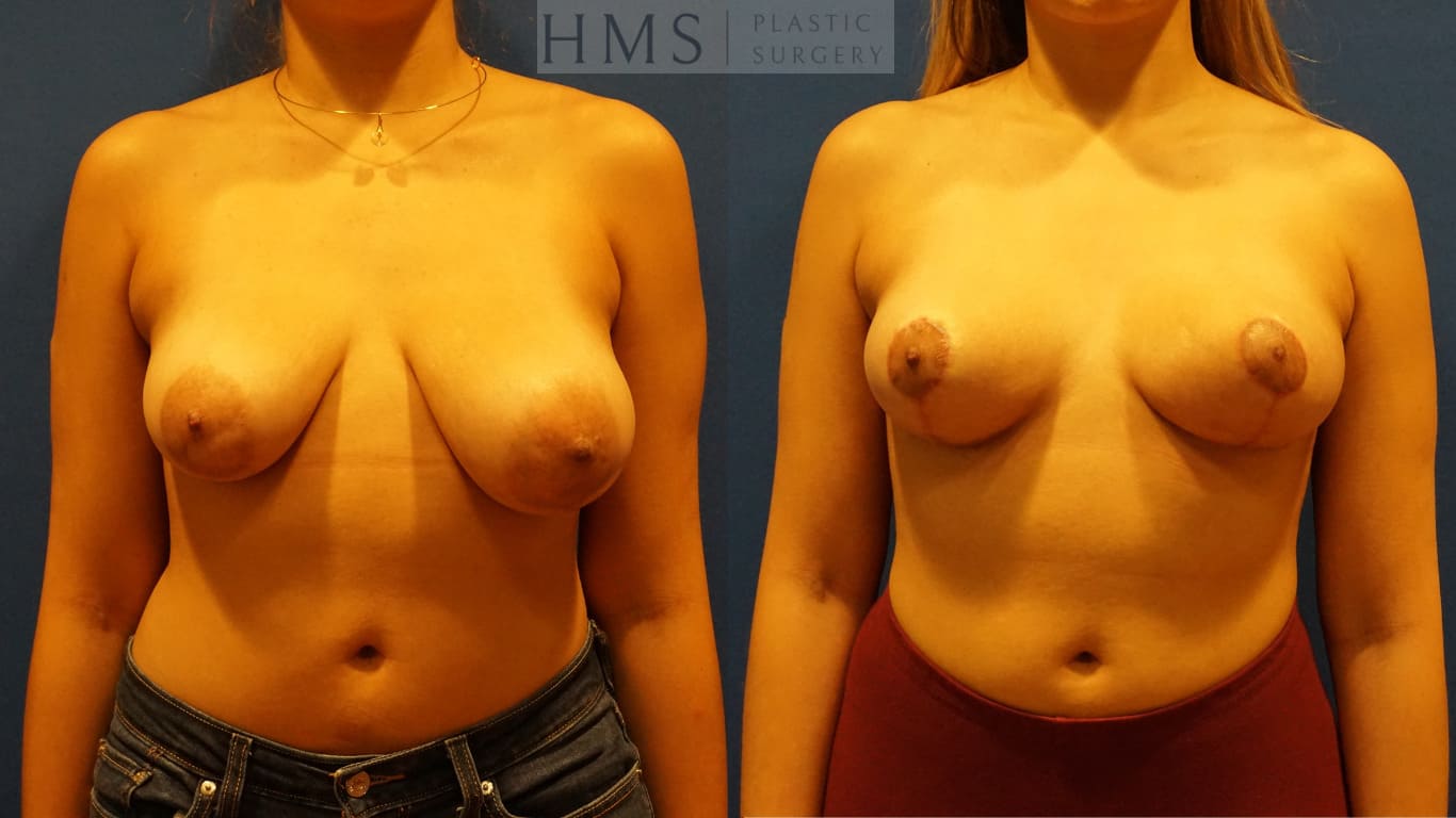 before and after Breast Reduction procedure