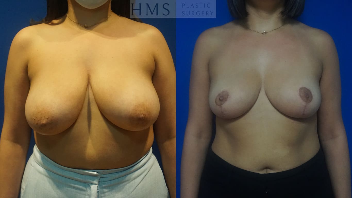 before and after Breast Reduction procedure