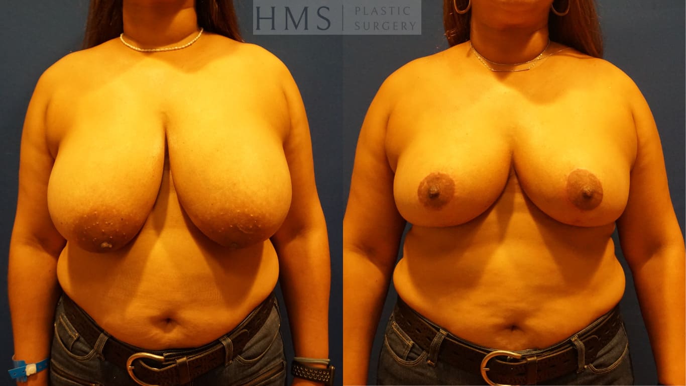 before and after Breast Reduction procedure