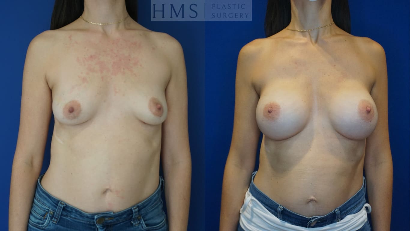 before and after Breast Reconstruction procedure