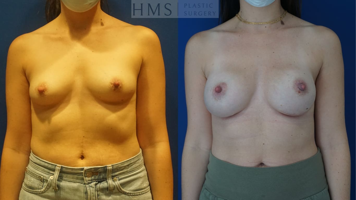before and after Breast Reconstruction procedure