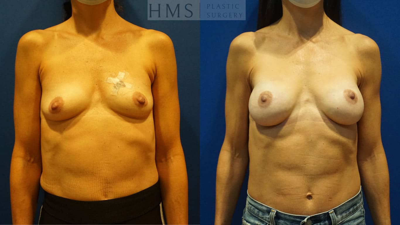 before and after Breast Reconstruction procedure