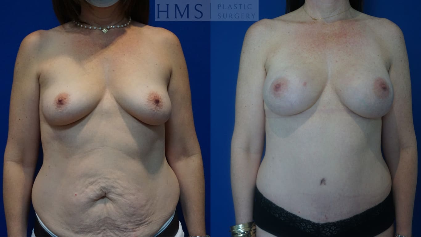 before and after Breast Reconstruction procedure