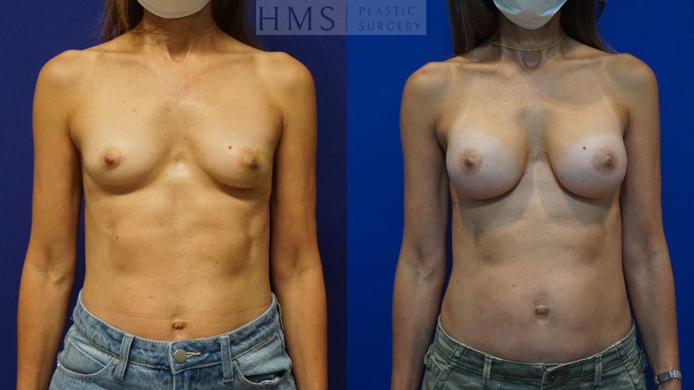 before and after Breast Reconstruction procedure