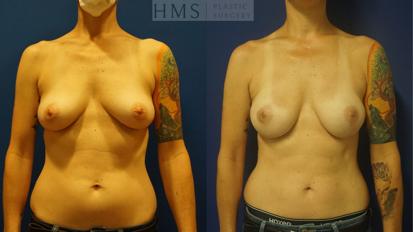before and after Breast Reconstruction procedure