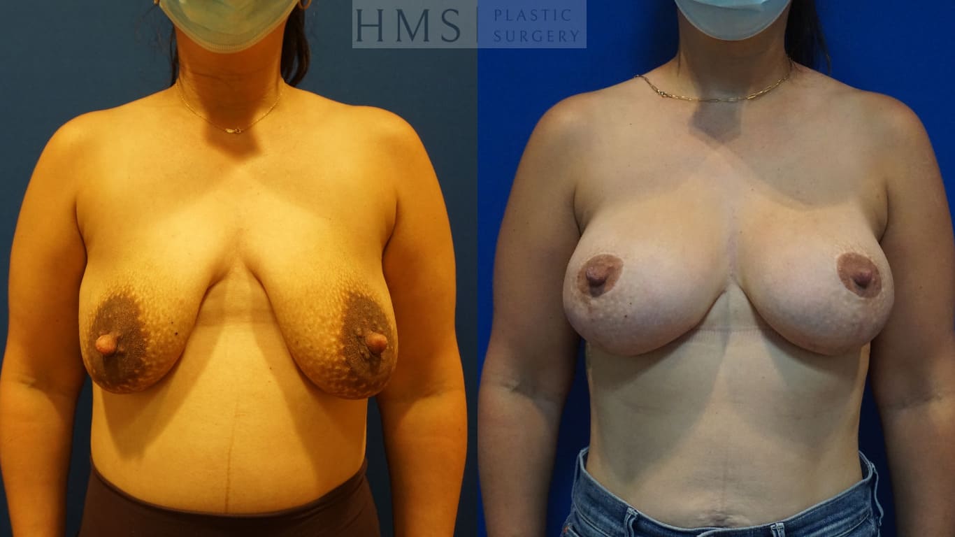 before and after Breast Reconstruction procedure