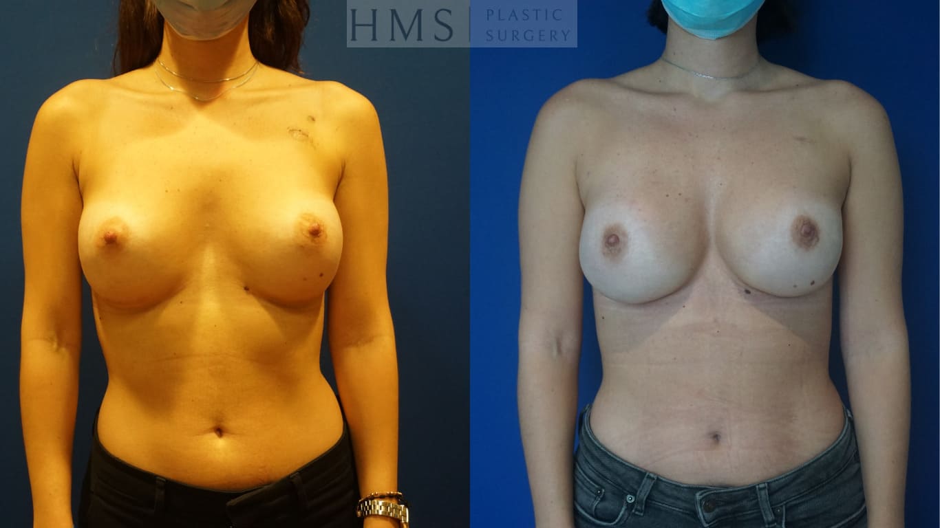 before and after Breast Reconstruction procedure