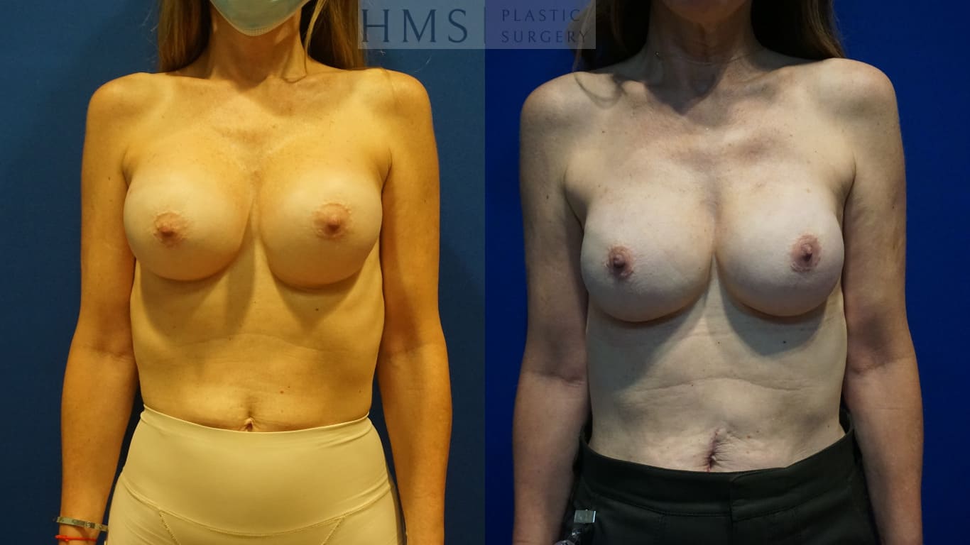 before and after Breast Reconstruction procedure