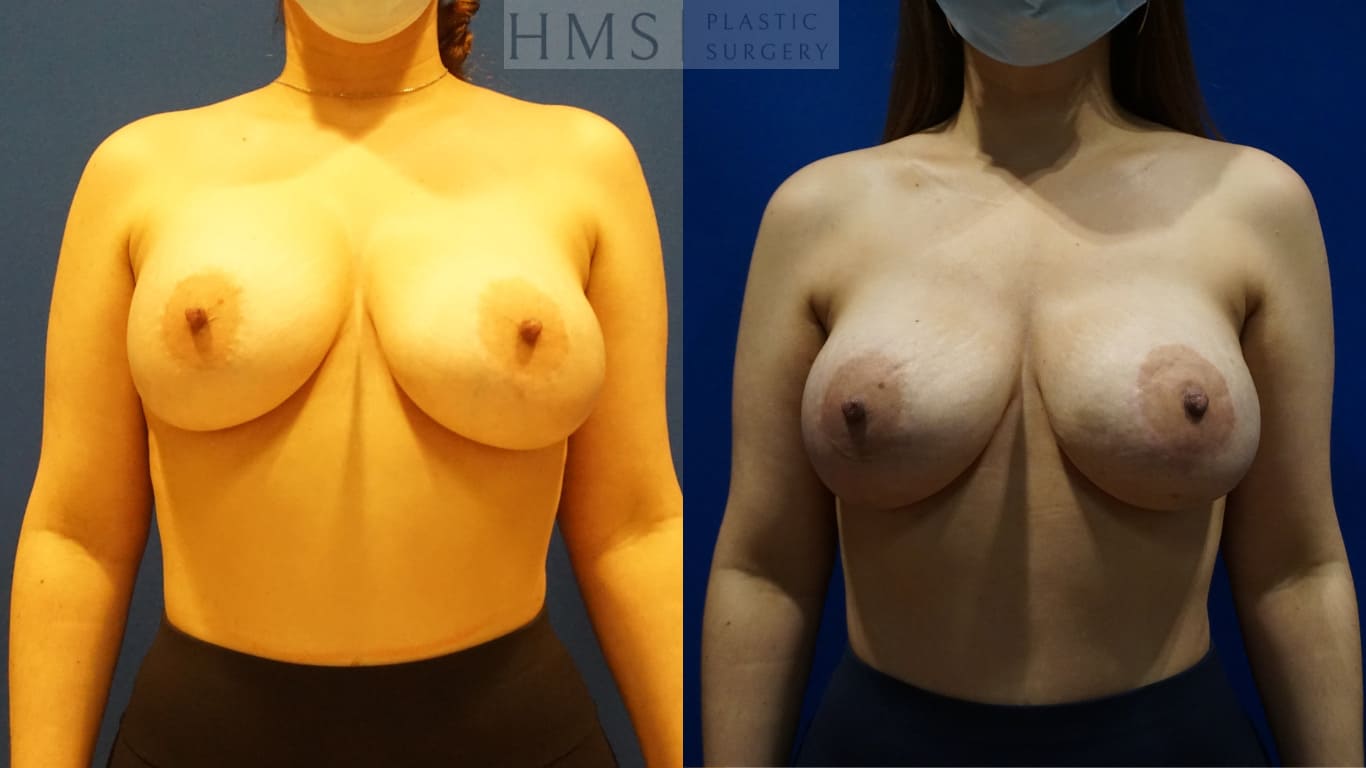 before and after Breast Reconstruction procedure