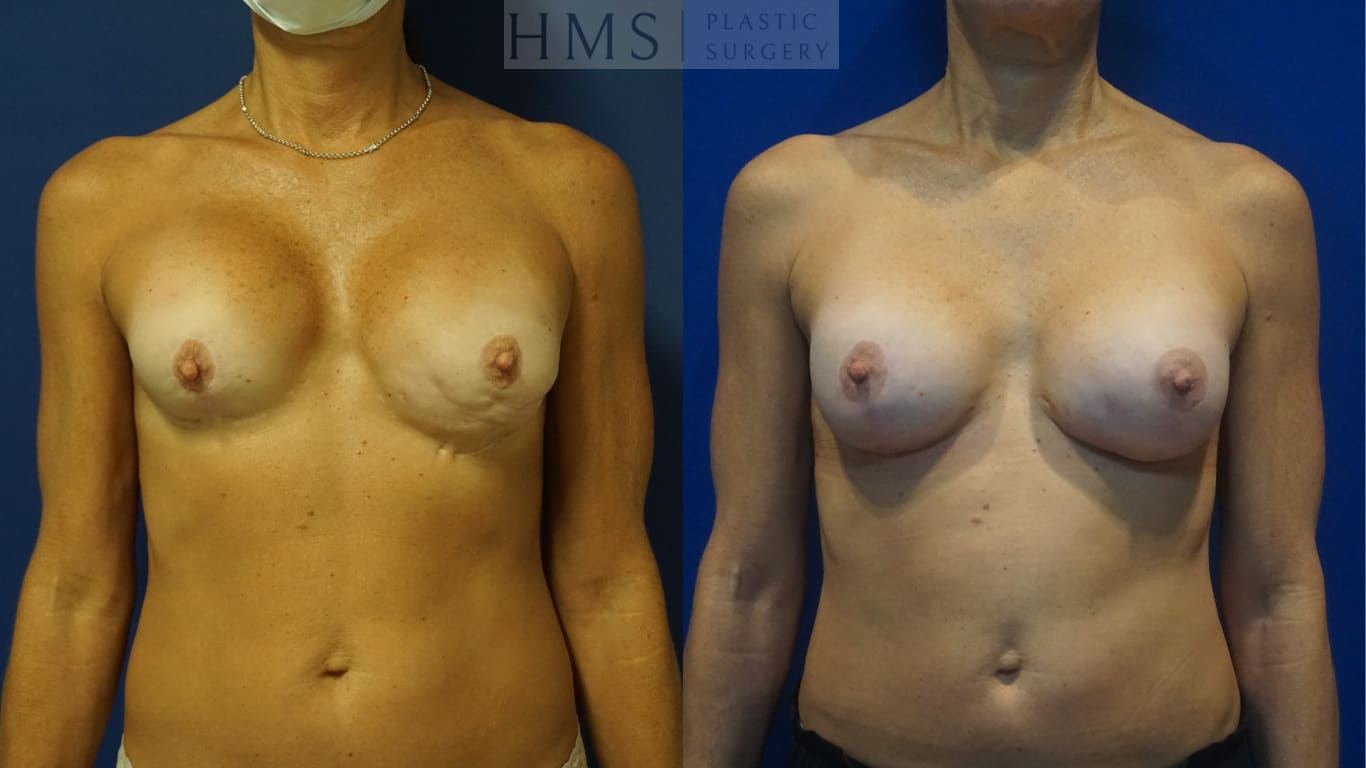 before and after Breast Aesthetic procedure