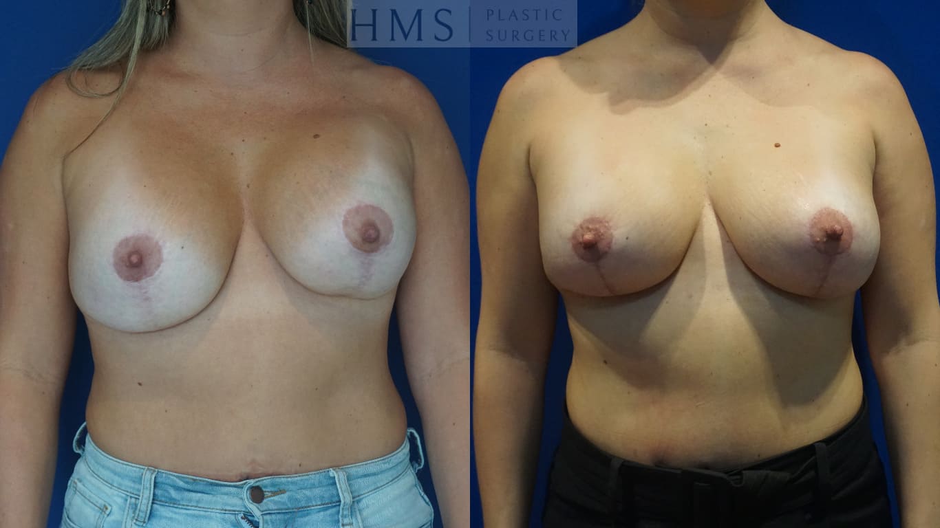 before and after Breast Aesthetic procedure