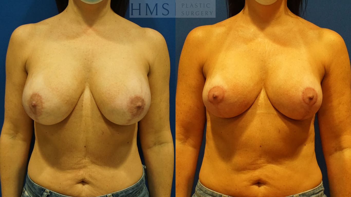 before and after Breast Aesthetic procedure