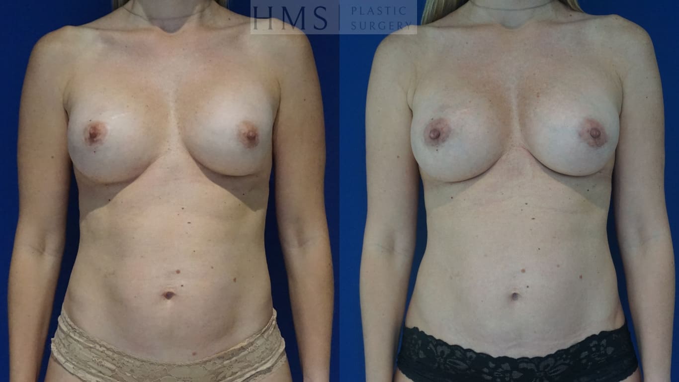 before and after Breast Aesthetic procedure