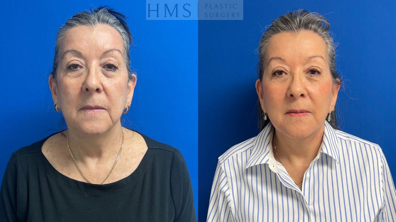 Before and after photo of a 69 year old female after Face and neck lift