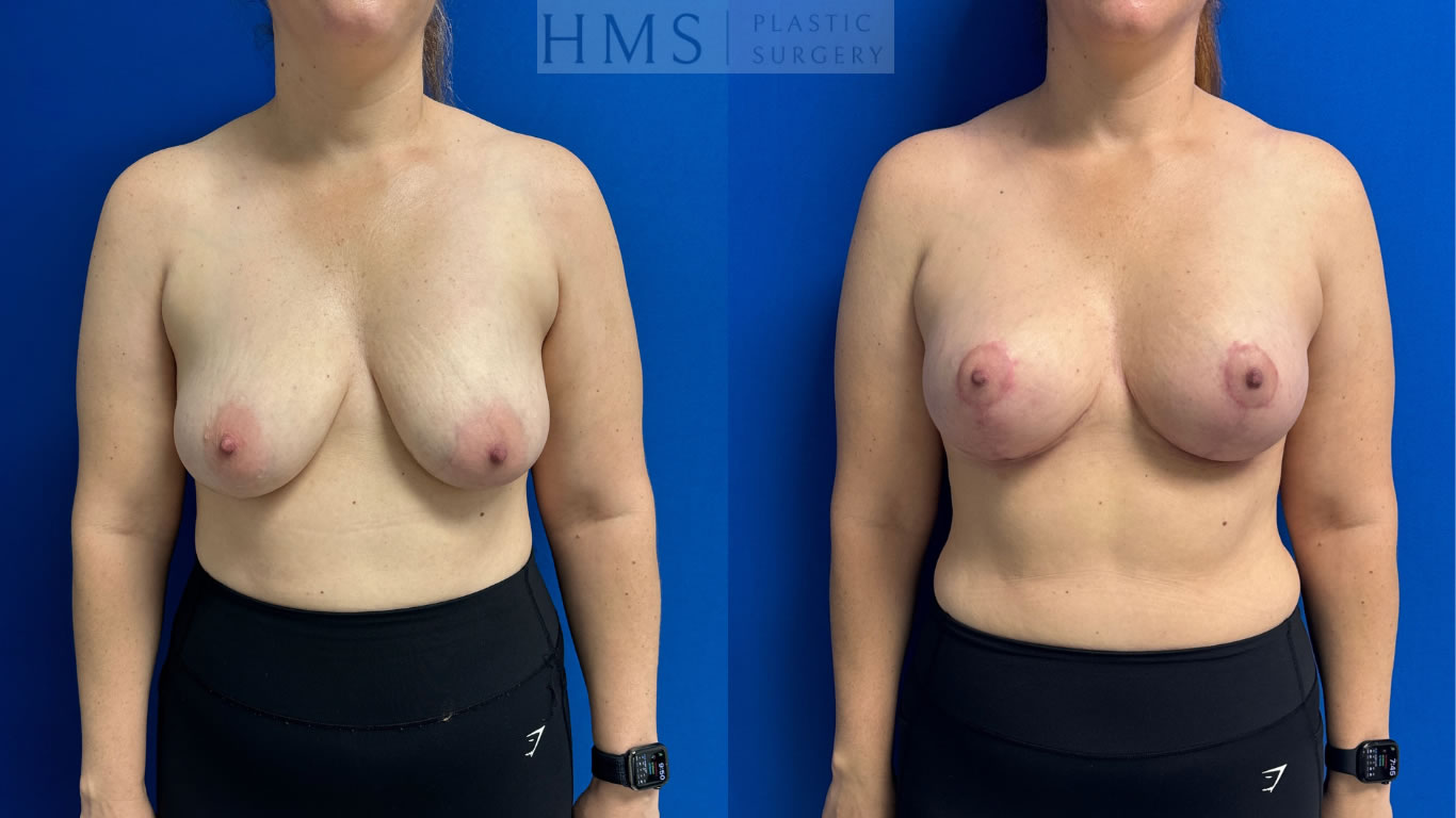 before and after photos of 38 year old female, 6 months postop Augmentation mastopexy