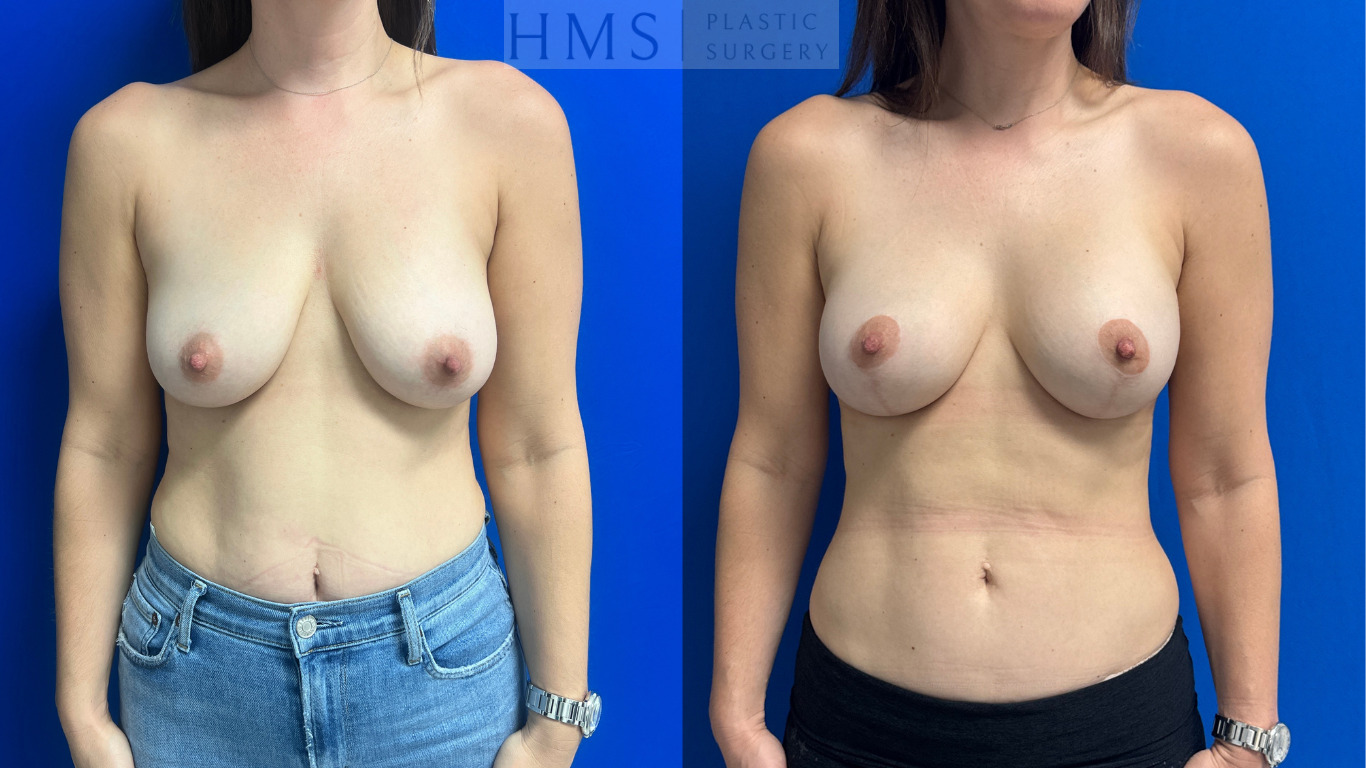 Before and 12-month postoperative photos of a 40-year-old female after bilateral implant placement and reduction mastopexy.