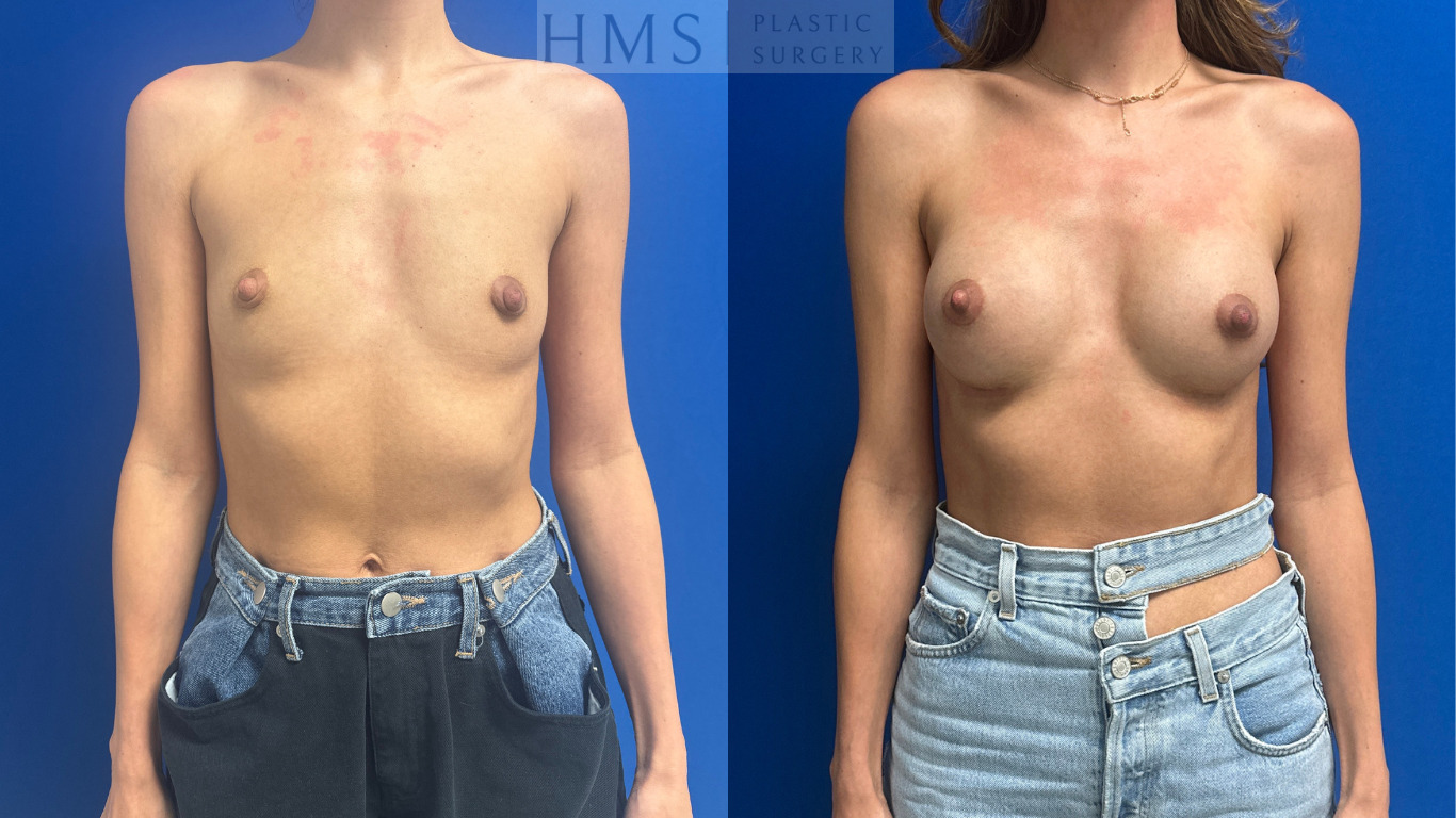 Before and after photos of a 31-year-old female after bilateral breast augmentation.