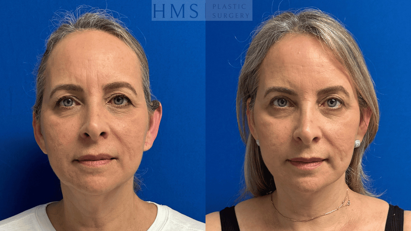 69-year-old woman before and one year after face and neck lift performed by Dr. Salinas, front