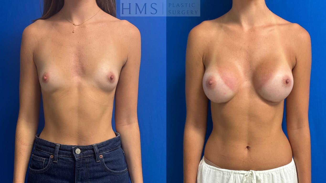 27 year old female before and after Bilateral breast augmentation, internal underwire 270cc smooth round moderate plus extra silicone implants, front view