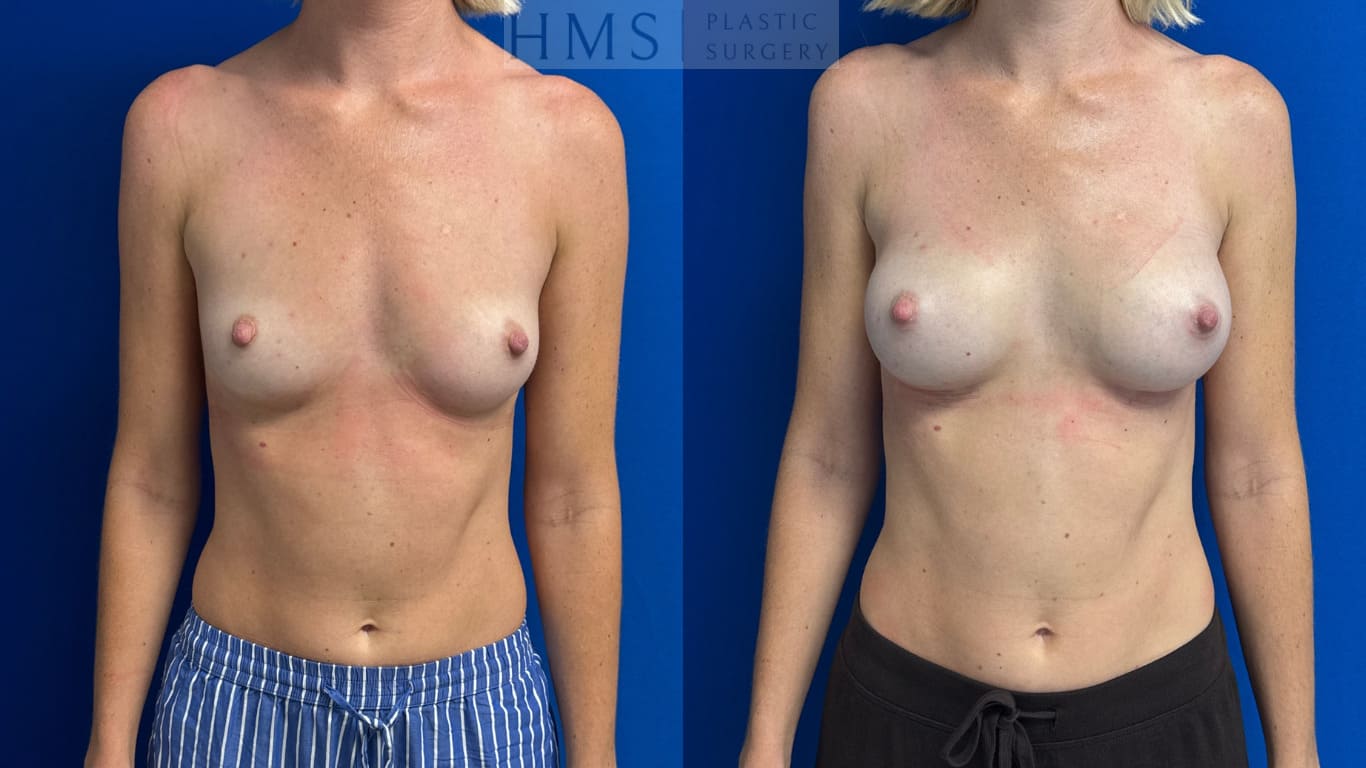 31 year old female before and after Bilateral breast augmentation, internal underwire 225cc smooth round moderate plus silicone implants