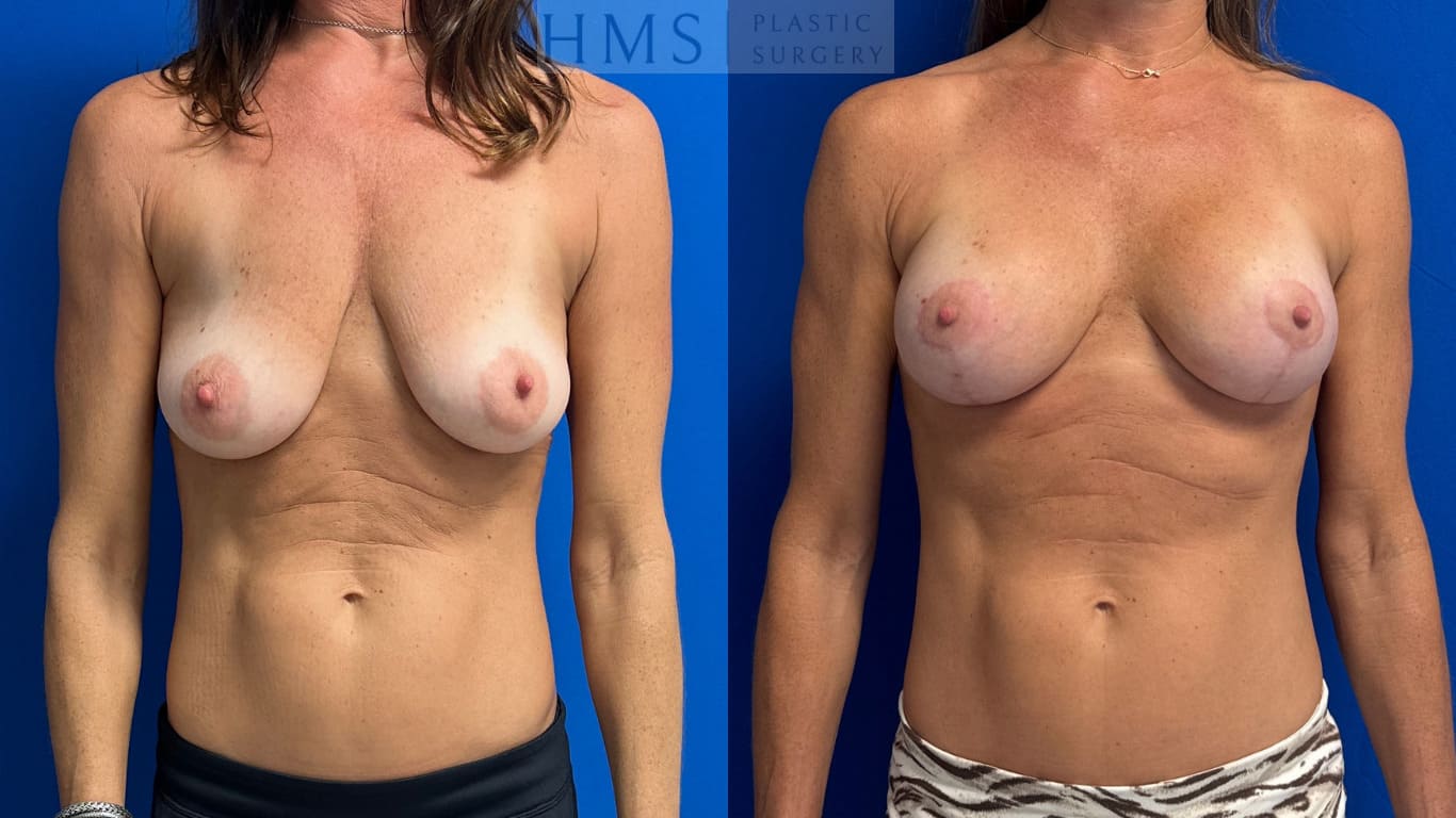 53 year old female before and 6 months after Bilateral implant placement and reduction/mastopexy 240cc smooth round moderate plus extra silicone implants Breast tissue removed: 94gm (right) 80gm (left)
